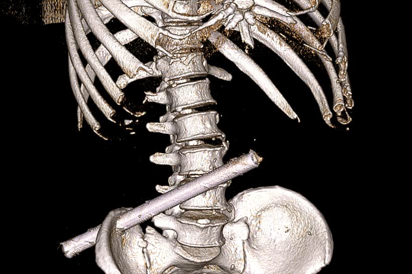 Новочебоксарские врачи извлекли из пациента 25 сантиметровую трубу.