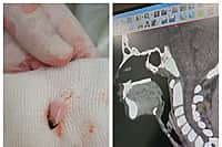 Ребёнка, проглотившего ноготь, спасли специалисты Республиканской детской клинической больницы.