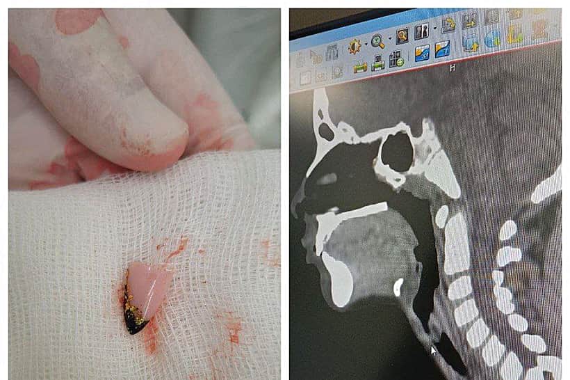 Ребёнка, проглотившего ноготь, спасли специалисты Республиканской детской клинической больницы.